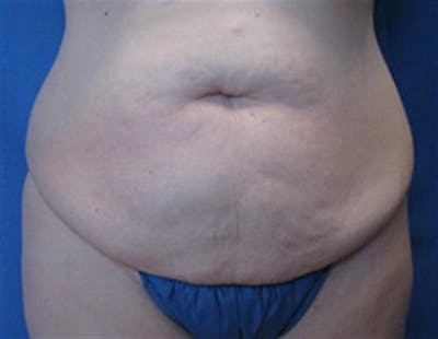 Tummy Tuck Before & After Gallery - Patient 230066 - Image 1