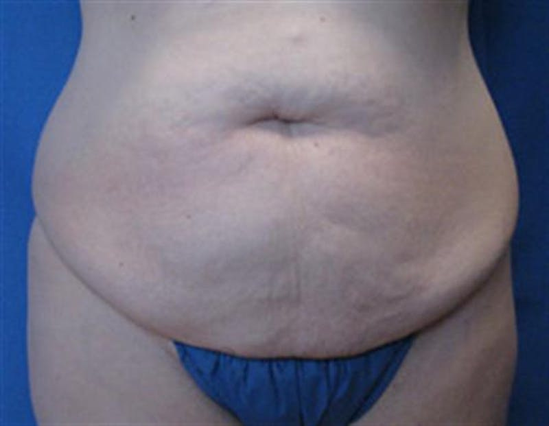 Tummy Tuck Before & After Gallery - Patient 230066 - Image 1