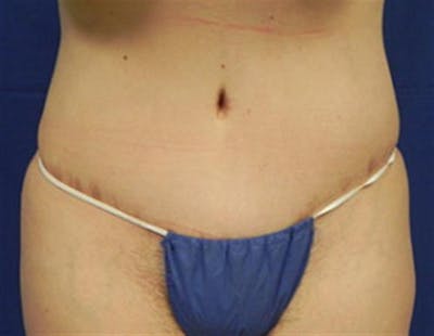 Tummy Tuck Before & After Gallery - Patient 230066 - Image 2