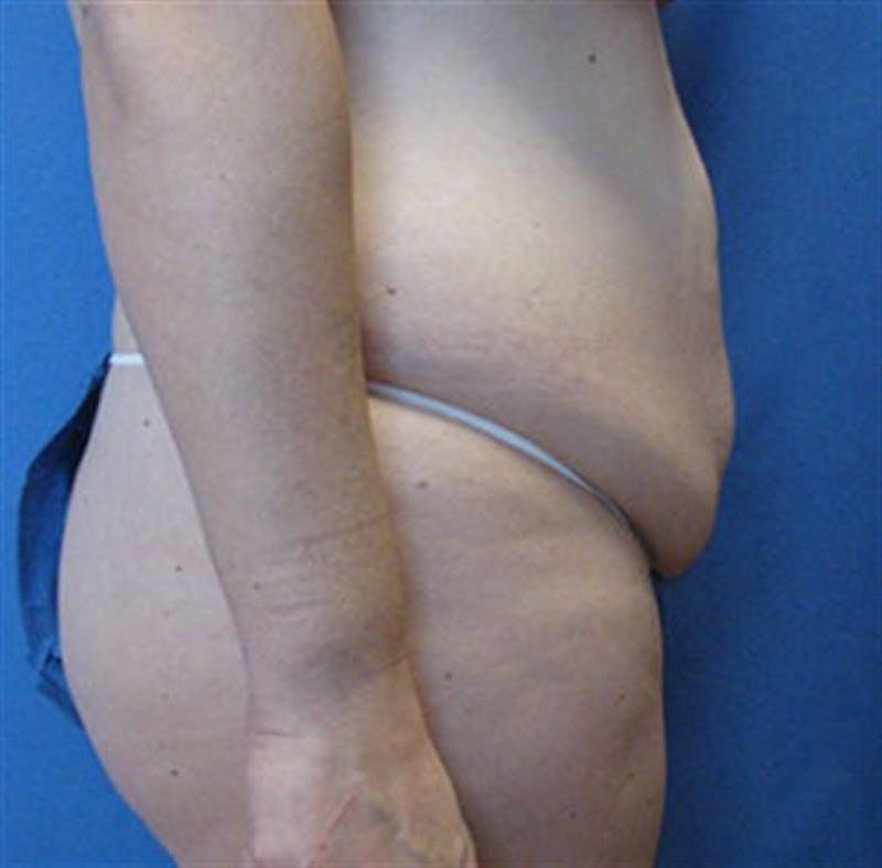 Tummy Tuck Before & After Gallery - Patient 230066 - Image 3