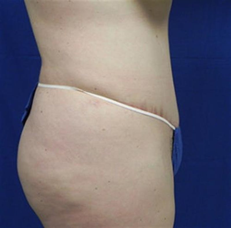 Tummy Tuck Before & After Gallery - Patient 230066 - Image 4