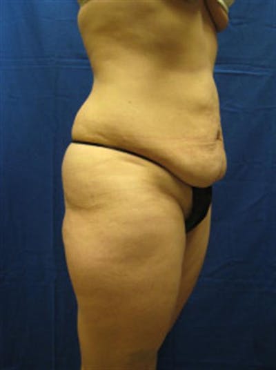 Tummy Tuck Before & After Gallery - Patient 303039 - Image 1
