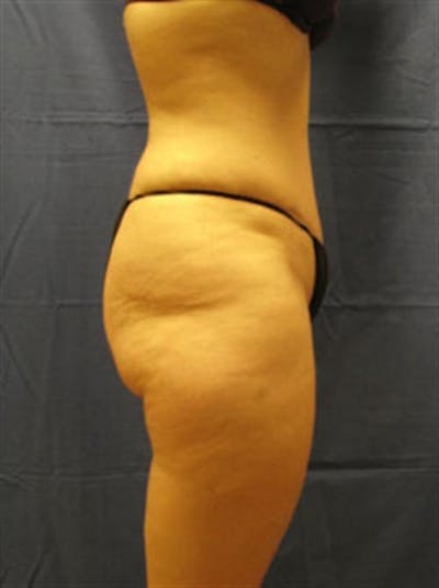 Tummy Tuck Before & After Gallery - Patient 303039 - Image 2