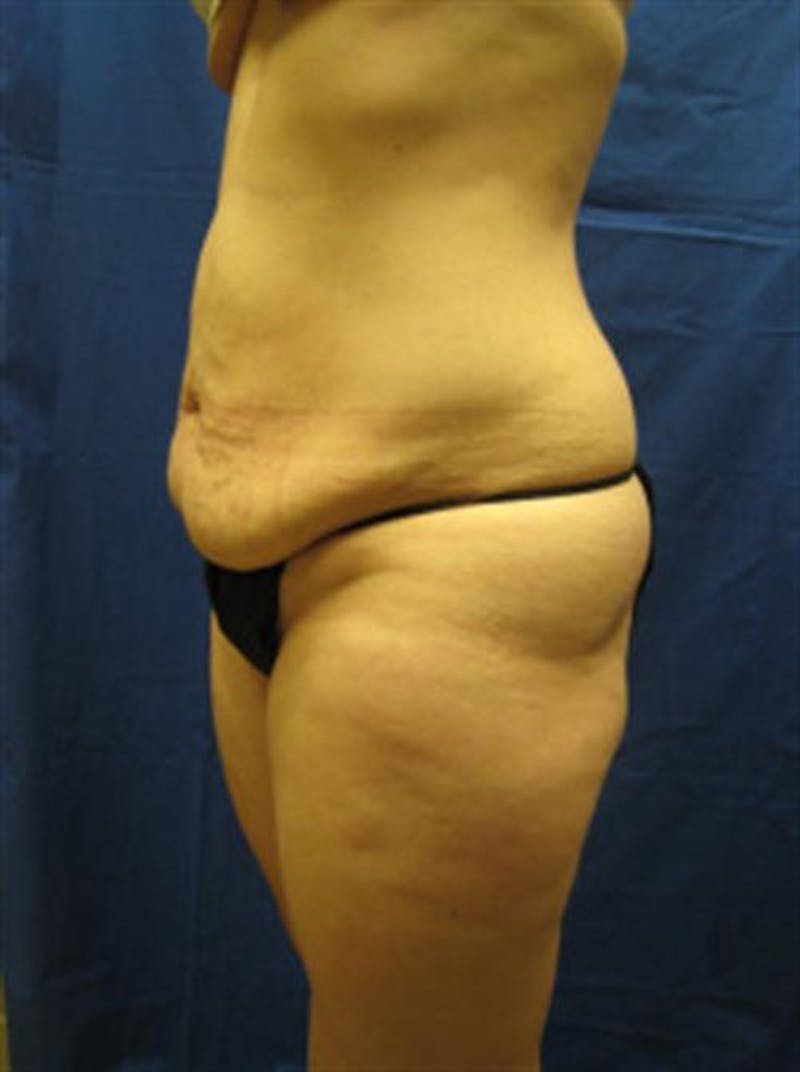 Tummy Tuck Before & After Gallery - Patient 303039 - Image 3