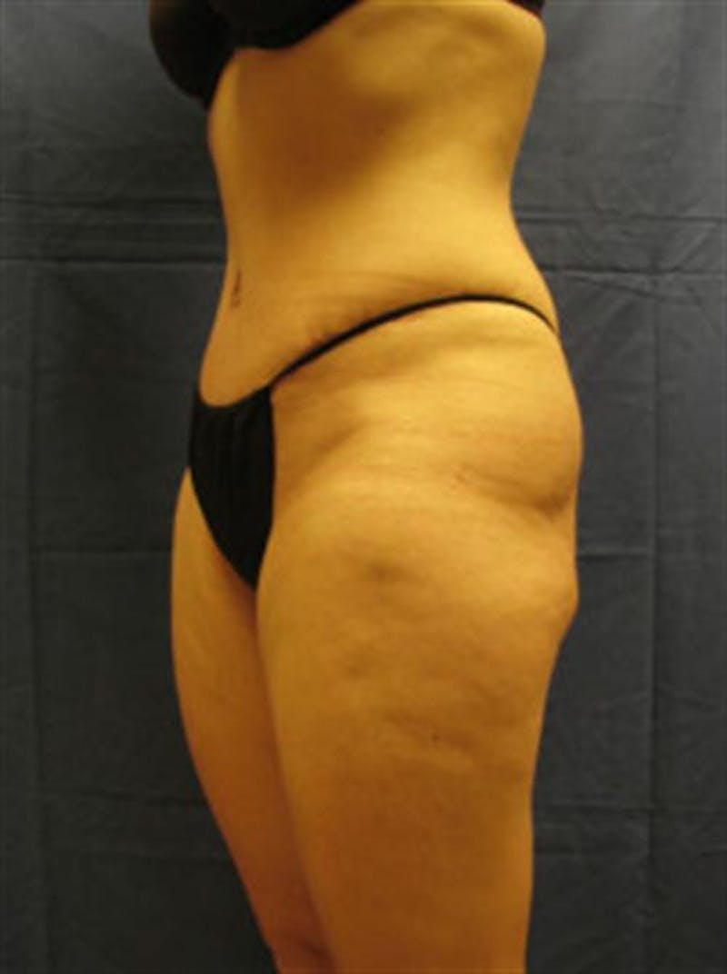Tummy Tuck Before & After Gallery - Patient 303039 - Image 4