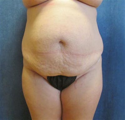 Tummy Tuck Before & After Gallery - Patient 190941 - Image 1
