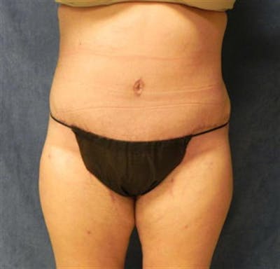 Tummy Tuck Before & After Gallery - Patient 190941 - Image 2