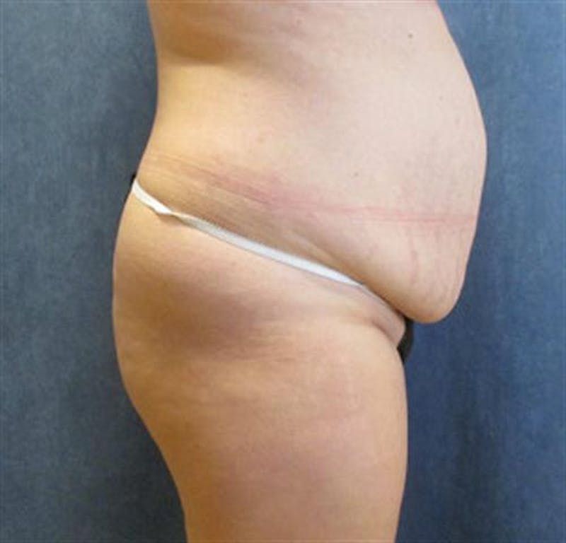 Tummy Tuck Before & After Gallery - Patient 190941 - Image 3