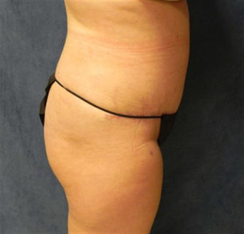 Tummy Tuck Before & After Gallery - Patient 190941 - Image 4