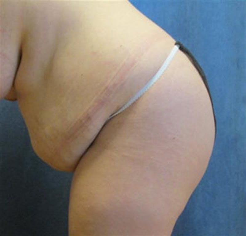 Tummy Tuck Before & After Gallery - Patient 190941 - Image 5