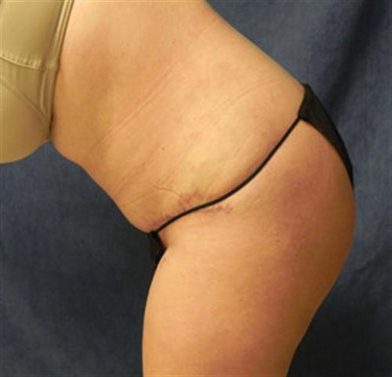 Tummy Tuck Before & After Gallery - Patient 190941 - Image 6