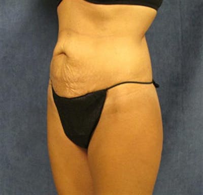 Tummy Tuck Before & After Gallery - Patient 330793 - Image 1
