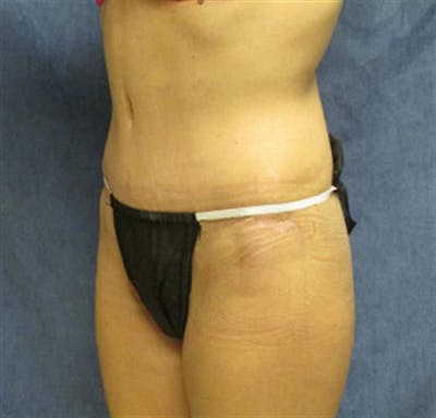 Tummy Tuck Before & After Gallery - Patient 330793 - Image 2