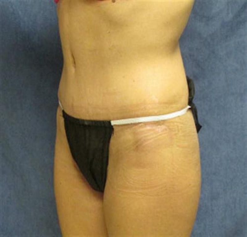 Tummy Tuck Before & After Gallery - Patient 330793 - Image 2