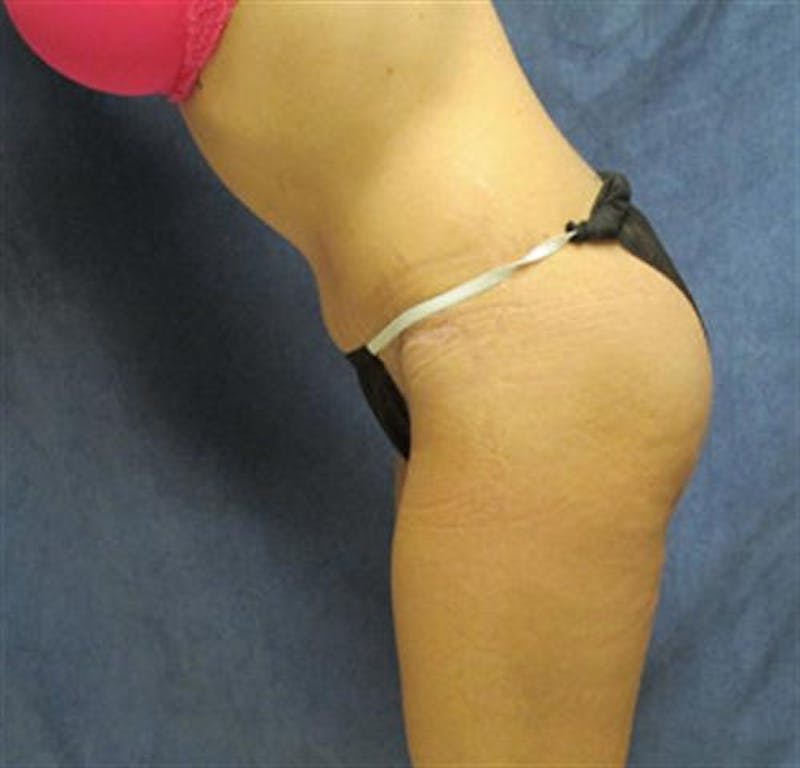 Tummy Tuck Before & After Gallery - Patient 330793 - Image 4