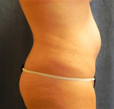 Tummy Tuck Before & After Gallery - Patient 300477 - Image 1