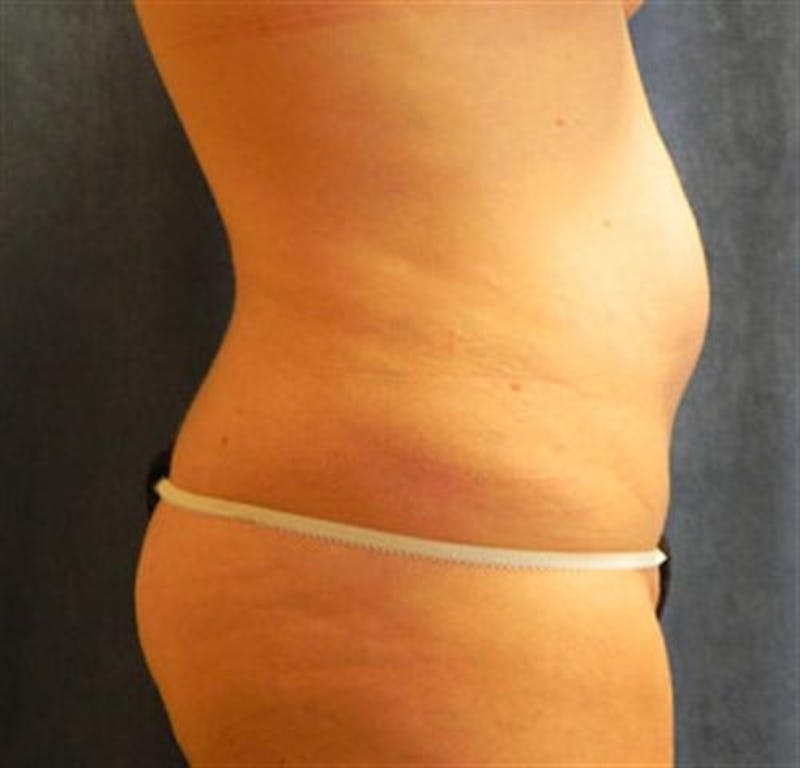 Tummy Tuck Before & After Gallery - Patient 300477 - Image 1