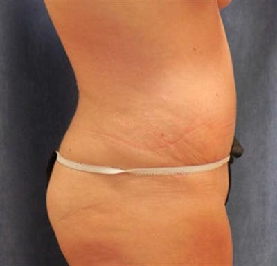 Tummy Tuck Before & After Gallery - Patient 300477 - Image 2