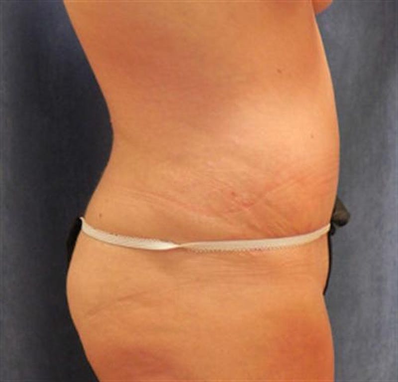 Tummy Tuck Before & After Gallery - Patient 300477 - Image 2