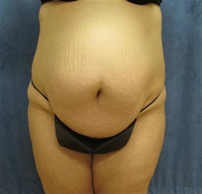 Tummy Tuck Before & After Gallery - Patient 359501 - Image 1