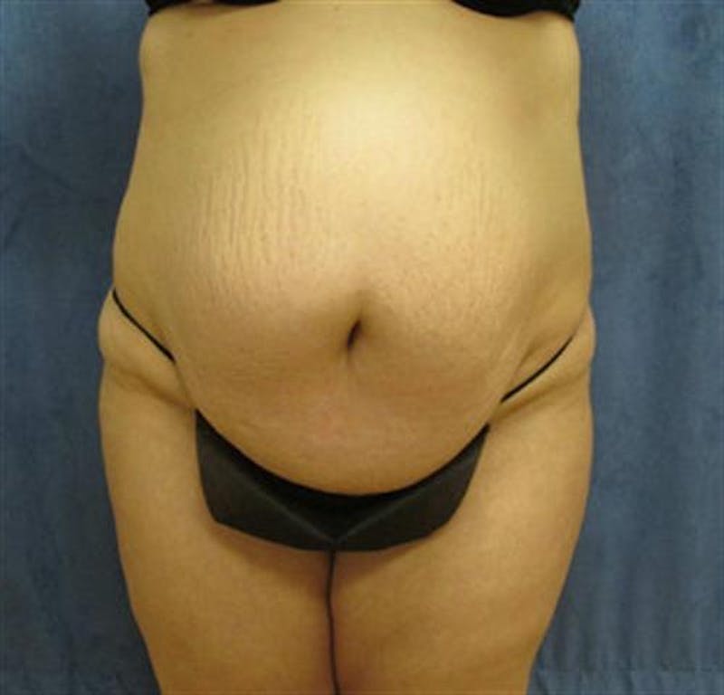 Tummy Tuck Before & After Gallery - Patient 359501 - Image 1