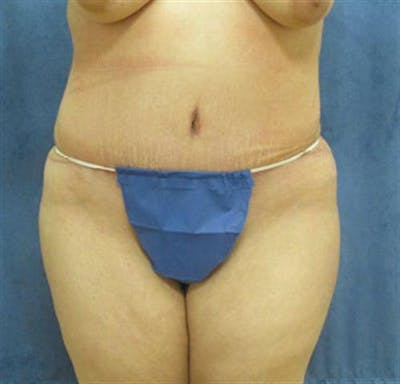 Tummy Tuck Before & After Gallery - Patient 359501 - Image 2