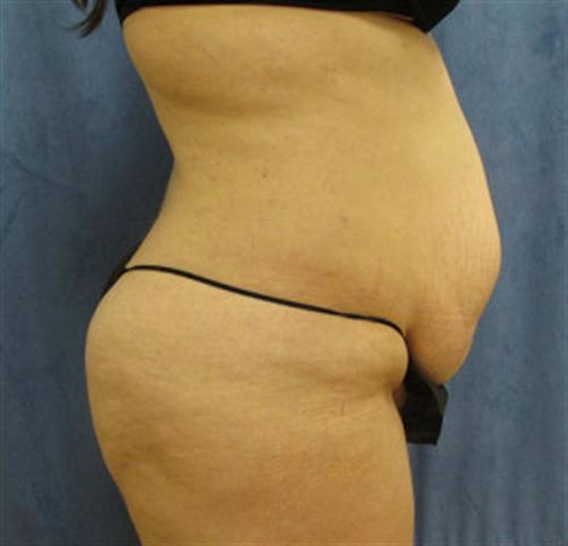 Tummy Tuck Before & After Gallery - Patient 359501 - Image 3