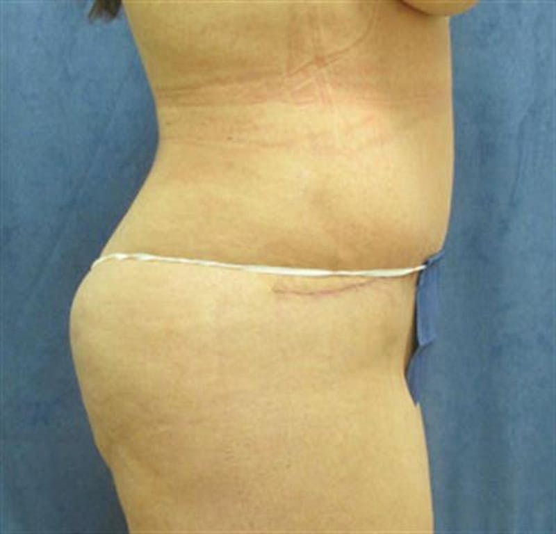 Tummy Tuck Before & After Gallery - Patient 359501 - Image 4