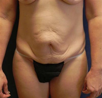 Tummy Tuck Before & After Gallery - Patient 387591 - Image 1