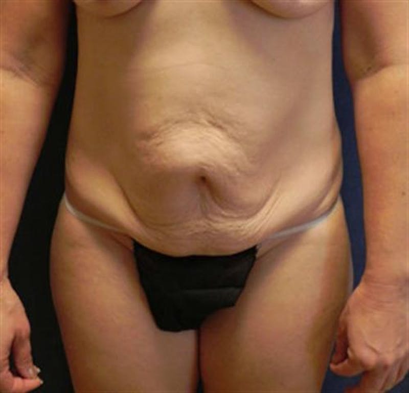 Tummy Tuck Before & After Gallery - Patient 387591 - Image 1