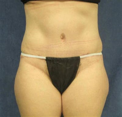 Tummy Tuck Before & After Gallery - Patient 387591 - Image 2