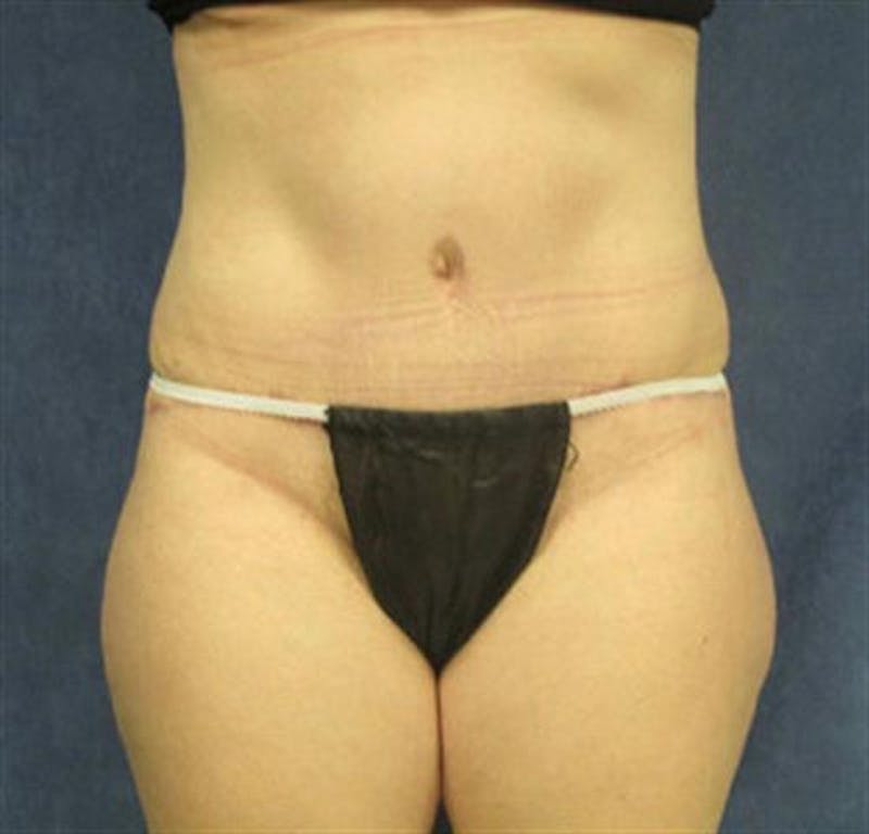 Tummy Tuck Before & After Gallery - Patient 387591 - Image 2