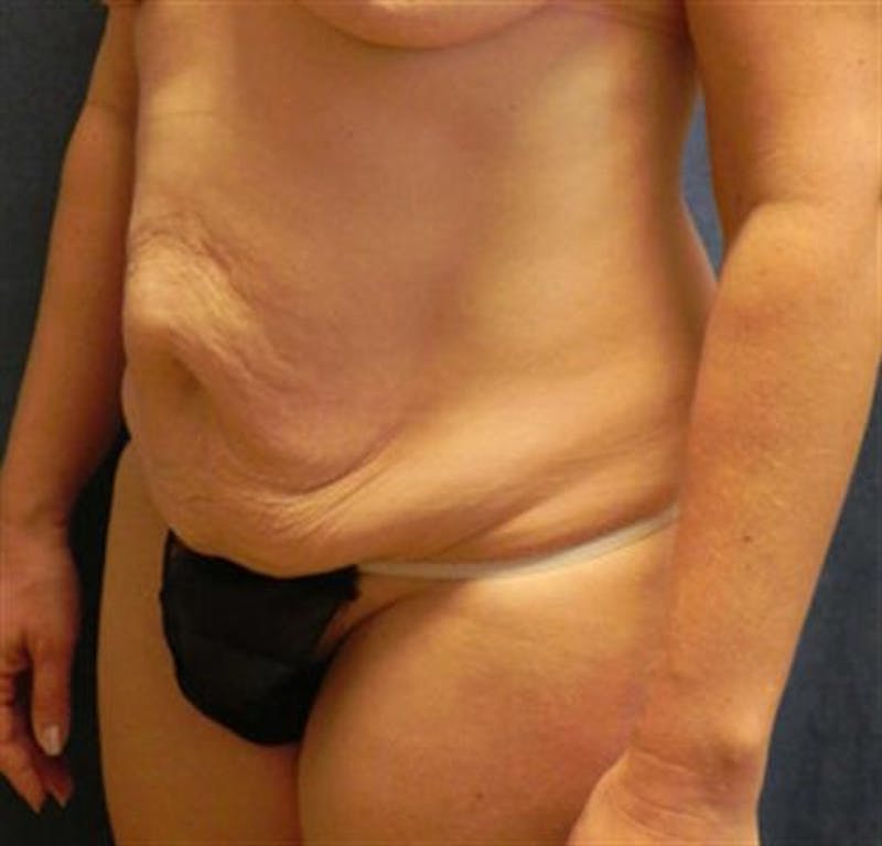 Tummy Tuck Before & After Gallery - Patient 387591 - Image 3