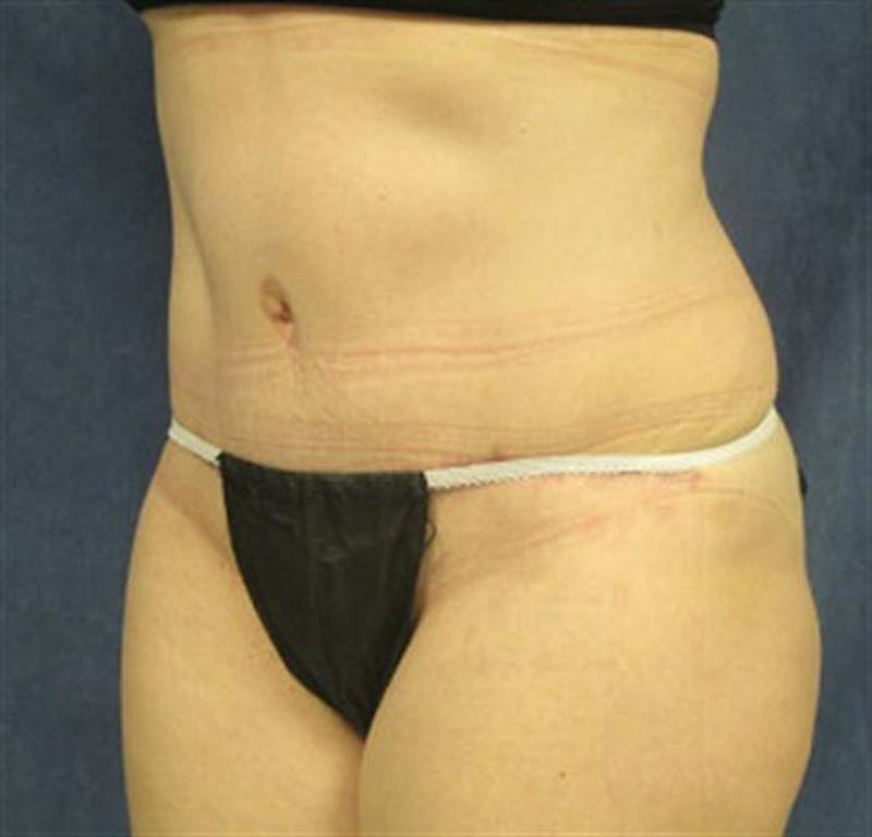Tummy Tuck Before & After Gallery - Patient 387591 - Image 4