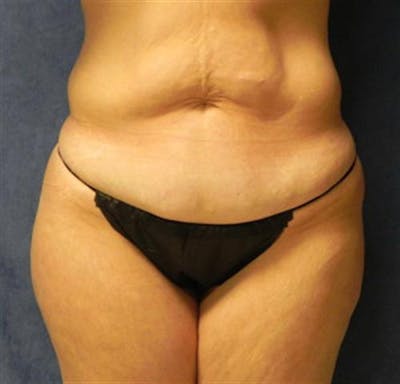 Tummy Tuck Before & After Gallery - Patient 260588 - Image 1