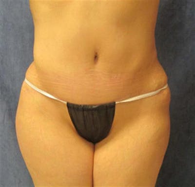 Tummy Tuck Before & After Gallery - Patient 260588 - Image 2