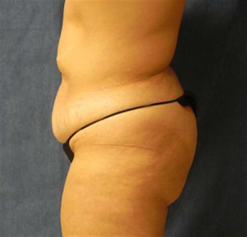 Tummy Tuck Before & After Gallery - Patient 260588 - Image 3