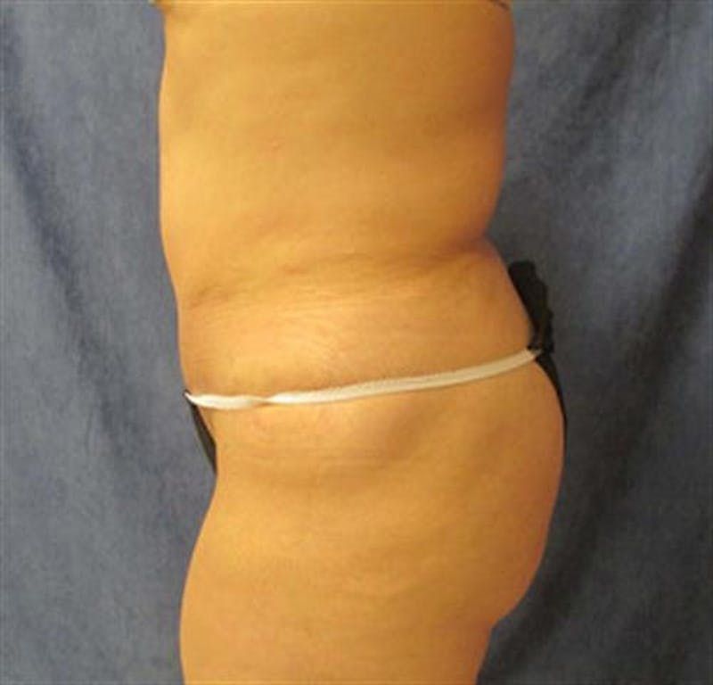Tummy Tuck Before & After Gallery - Patient 260588 - Image 4