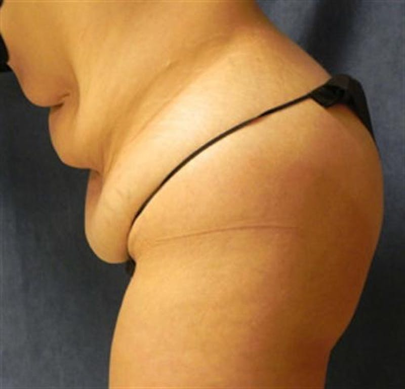 Tummy Tuck Before & After Gallery - Patient 260588 - Image 5