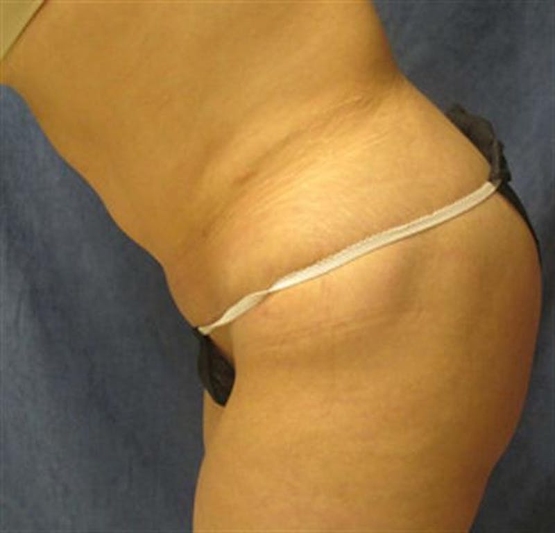 Tummy Tuck Before & After Gallery - Patient 260588 - Image 6