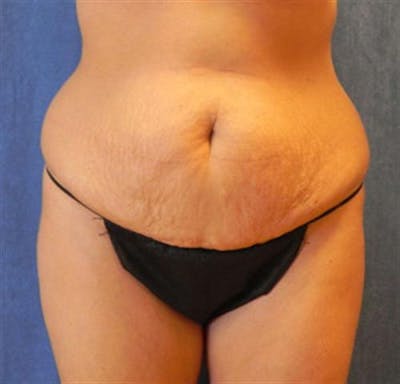 Tummy Tuck Before & After Gallery - Patient 245179 - Image 1