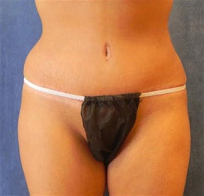 Tummy Tuck Before & After Gallery - Patient 245179 - Image 2