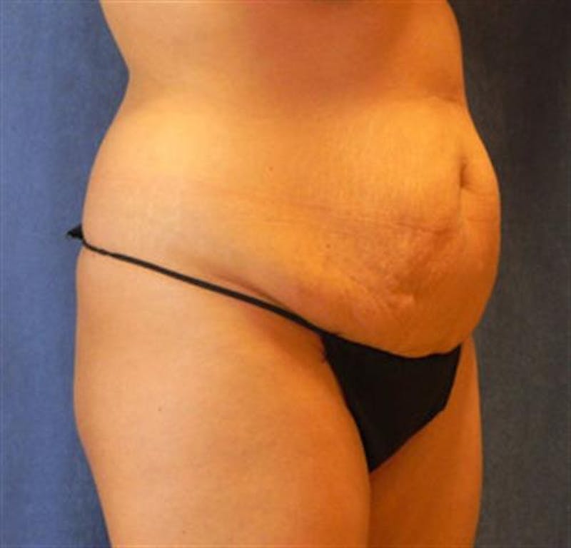 Tummy Tuck Before & After Gallery - Patient 245179 - Image 3