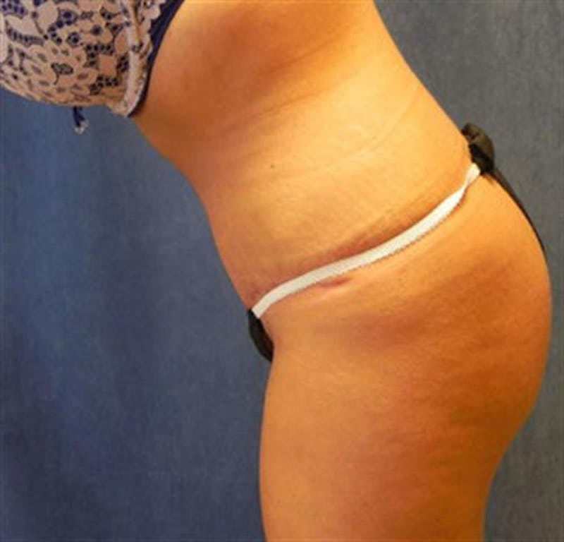 Tummy Tuck Before & After Gallery - Patient 245179 - Image 6