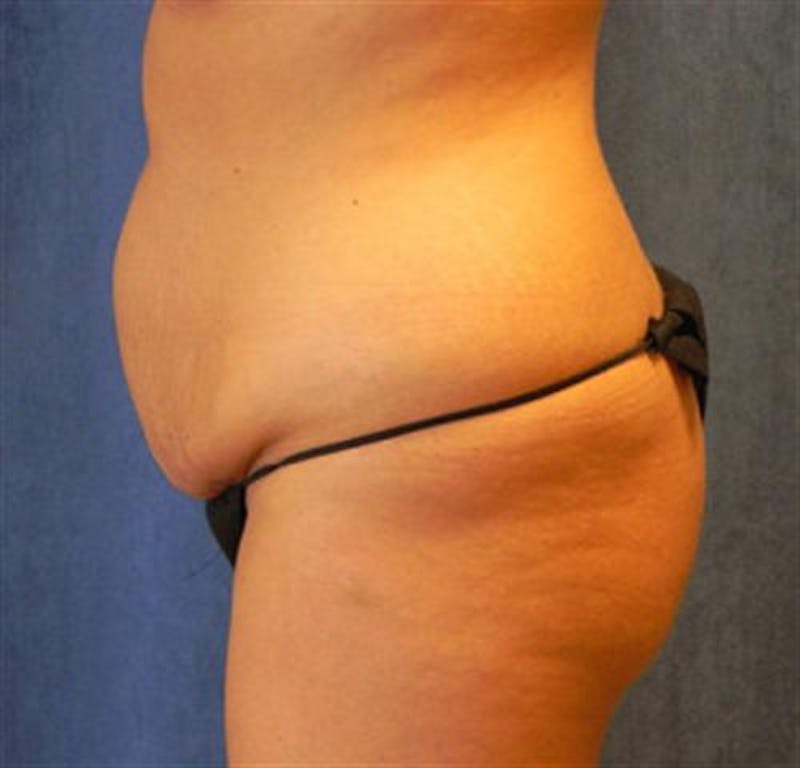 Tummy Tuck Before & After Gallery - Patient 245179 - Image 7