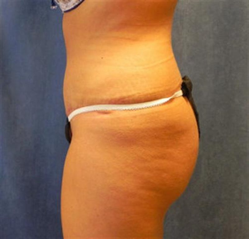 Tummy Tuck Before & After Gallery - Patient 245179 - Image 8