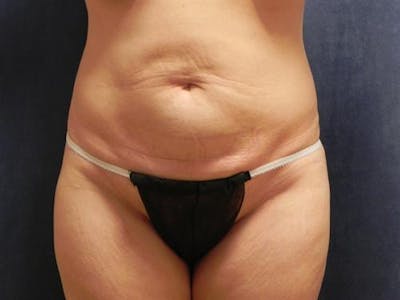 Tummy Tuck Before & After Gallery - Patient 247134 - Image 1