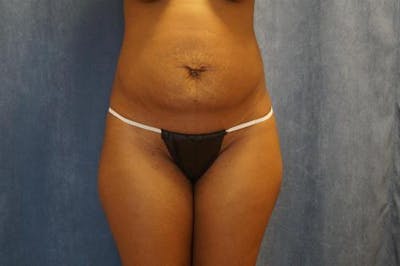 Tummy Tuck Before & After Gallery - Patient 233394 - Image 1