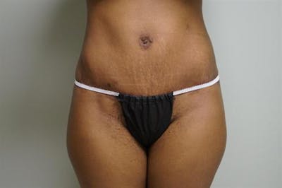 Tummy Tuck Before & After Gallery - Patient 233394 - Image 2