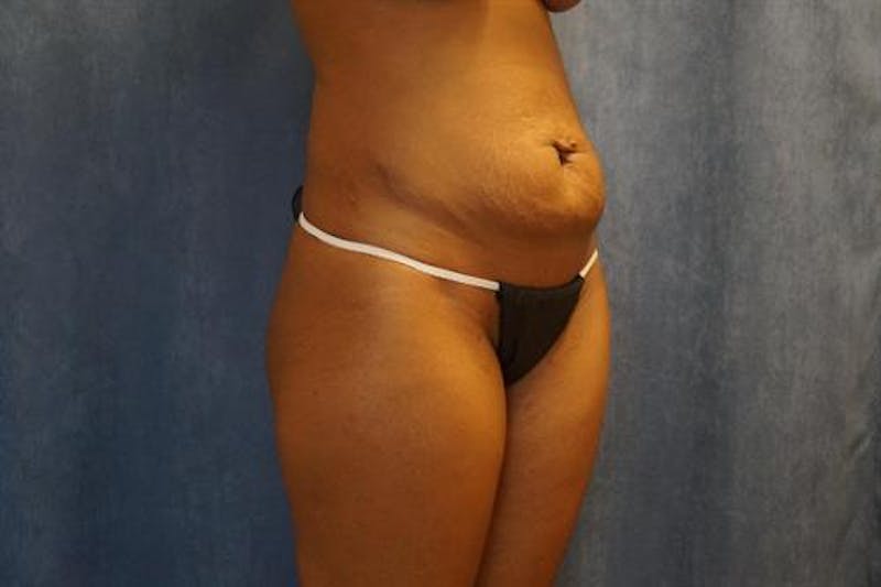 Tummy Tuck Before & After Gallery - Patient 233394 - Image 3